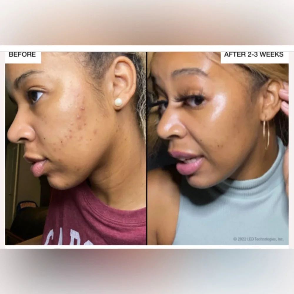 reVive‎ Glo Wrinkle Treatment Device